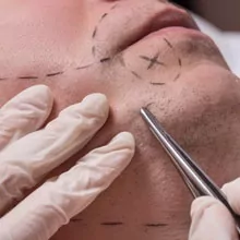 Beard Transplant in Bangalore