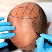 FUE Hair Transplant in Bangalore