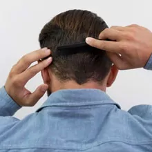 FUT Hair Transplant in Bangalore
