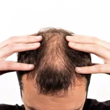 Hair Loss Treatment in Bangalore