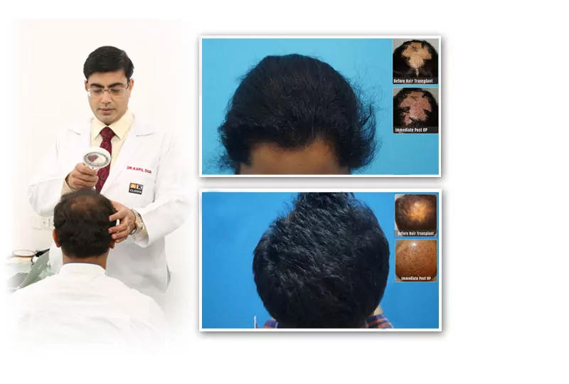 Best Hair Transplant Results in Bangalore