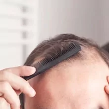 Hairline Correction Surgery in Bangalore