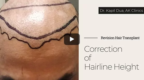 Hairline Re-construction Surgery